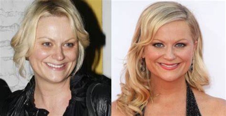 Did Amy Poehler get facelift surgery? Personal life Info Explored