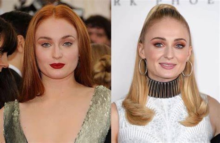 Did Sophie Turner Really Get Buccal Fat Removal After Joe Jonas Admitted To Using Injectables In