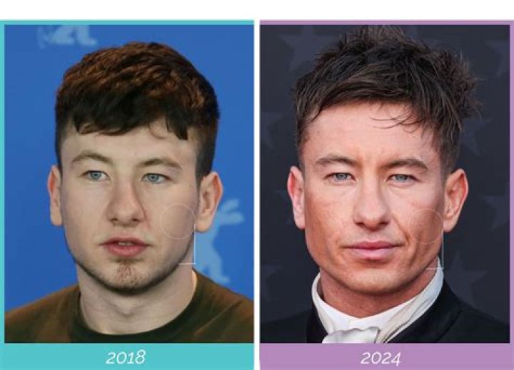 Has Barry Keoghan Done Facial Plastic Surgery?