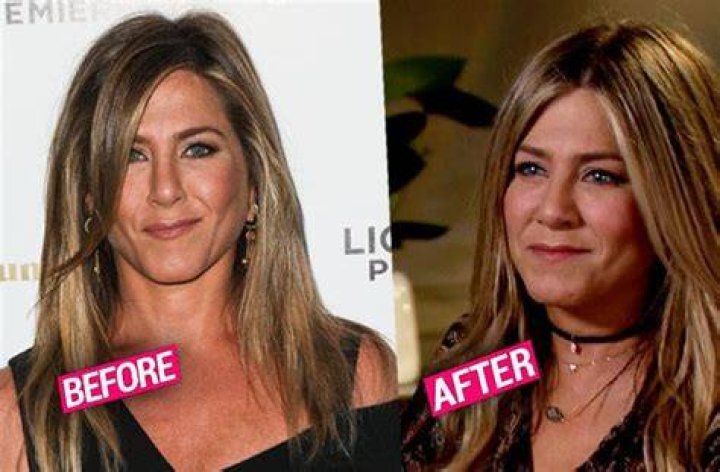 Jennifer Aniston Plastic Surgery Revelation: Botox, Fillers, and More