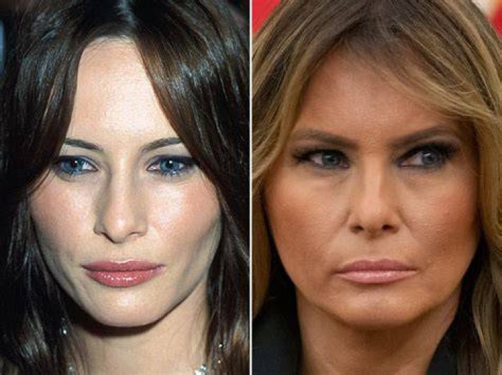 Melania Trump, Before and After The Skincare Edit Cheek fillers, Face fillers, Under eye fillers