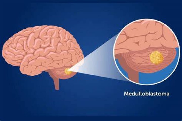 What is medulloblastoma? As Michael Strahan's teen daughter reveals brain tumor diagnosis